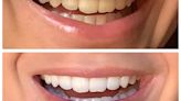 Users love these peroxide-free teeth whitening strips