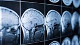 Científicos chinos reviven un cerebro humano que llevaba congelado 18 meses