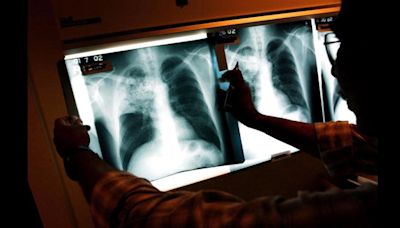 Long Beach detects localized tuberculosis outbreak