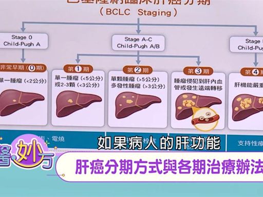 肝癌不同期別治療方式不同