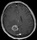 Brain tumor