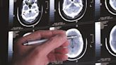 Study shows risk for developing Alzheimer’s increases in older adults who had COVID-19