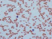 Sickle cell trait