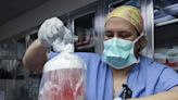 A dos meses de la operación: muere el hombre que recibió el primer transplante de riñon de cerdo - La Tercera