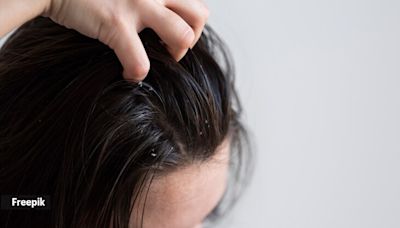 When is the ‘lice season’ and how can you stay safe?