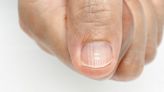 The Real Reason for Ridges on Fingernails, According to Doctors
