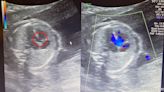 試管雙胞胎心臟異常 胎兒超音波發現罹「法洛氏」心臟病
