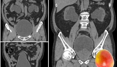 攝護腺大到像芒果！他攝護腺壓迫尿道「慢性腎衰竭」再拖恐洗腎