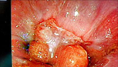 男子健檢 發現罕見胃瘜肉 - 自由健康網