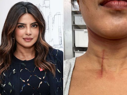 Priyanka Chopra Shares Image of Neck Cut Suffered Doing Stunts on New Movie: ‘Hazards on My Jobs’