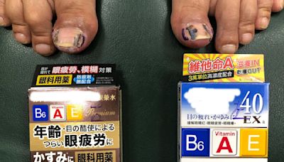 眼藥水改善甲溝炎！關鍵成分是它 維他命B眼藥水、青光眼藥水都有效