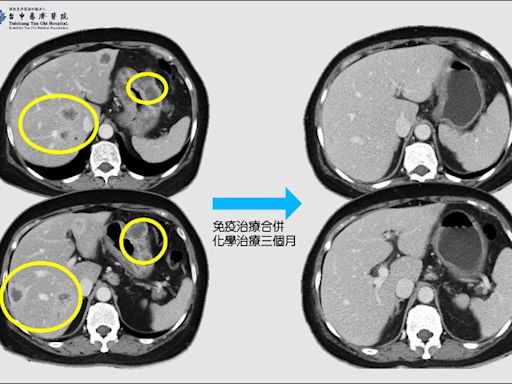 胃癌4期轉移肝臟 免疫治療合併化療治癒 - 自由健康網