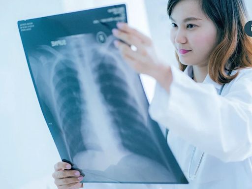 肺癌篩檢發現「肺部小結節」怎麼辦？醫列「4種情況」有機會自己消失