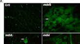 Study finds LED therapy and antioxidant drug benefit muscle regeneration in Duchenne muscular dystrophy