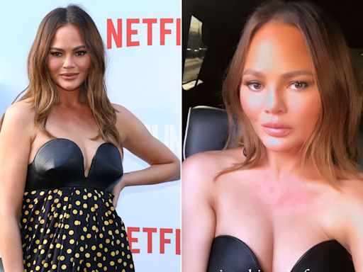 Chrissy Teigen Shares Clip of Her 'Anxiety Hives' Ahead of Red Carpet Appearance: 'Every Event'