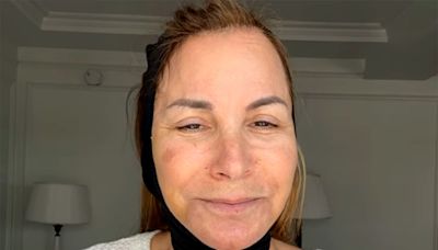 RHONY's Jill Zarin Underwent 'Facial Rejuvenation' Surgery to Address Her 'Jowling, Sagging Neck Skin', Doc Says