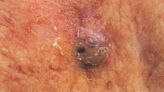 Study Examines Merkel Cell Carcinoma in Non-White Hispanics