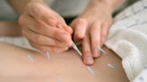 Acupuncture is used to treat many conditions. Is weight loss one?