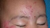 What Can Cause a Rash on My Baby's Face?