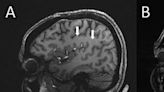A step toward figuring out migraines? Scans show how the condition affects the brain