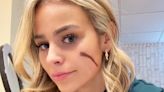 TikTok's "Scar Girl" Annie Bonelli Reacts to Claims Her Cheek Mark Is Fake