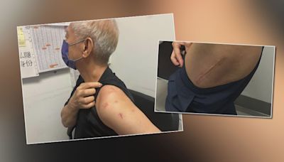 聯合醫院引新手術治肩膊旋轉肌撕裂 加快病人康復