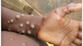 Mpox infections double last year's rate in U.S.