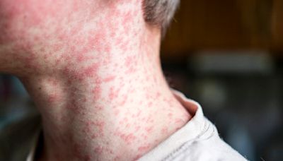Ontario records first measles death since 1989. What parents need to know about the disease & vaccination