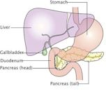 Pancreatic cancer