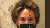 Lydia Bosch muestra las heridas de su rostro tras sufrir un accidente con un skate