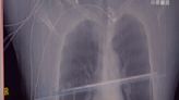 空汙害肺腺癌！台大研究「高於吸菸者1.044倍」