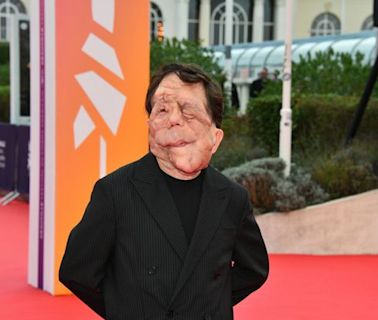 Qu’est-ce que la neurofibromatose, la maladie dont souffre l’acteur Adam Pearson ?