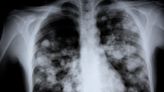 What Exactly Is 'White Lung Pneumonia' — and Should You Be Worried?