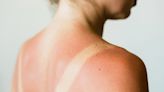 Do you have heat rash or sun poisoning? Look for these important differences, derms say