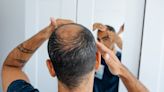 7 Ways to Treat a Receding Hairline, According to Dermatologists