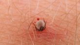 Lyme disease increase risk due to climate change