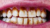 Dientes amarillos: el truco para que el café no los manche