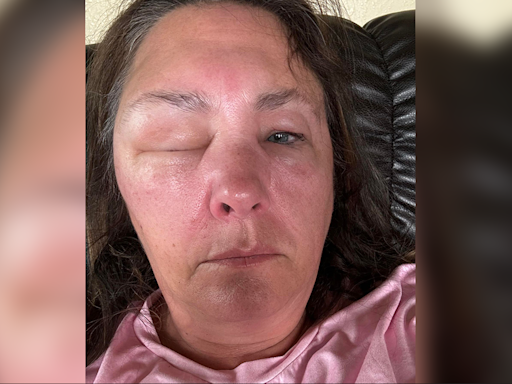 Topeka woman shares warning after suspected spider bite sends her to the ER