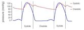 Essential hypertension