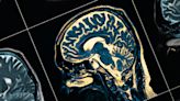 University of Virginia research provides better understanding of Alzheimer’s, epilepsy