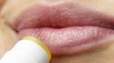 Calenturas o herpes labial: Síntomas y tratamiento de unas pupas muy dolorosas y contagiosas