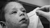 Ever had a bad case of chickenpox? If you're under 30, probably not, thanks to vaccine, report finds