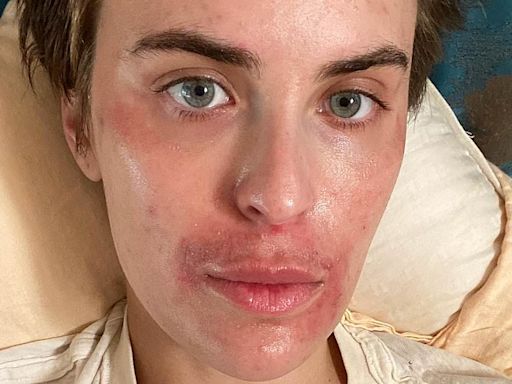 Demi Moore's daughter Tallulah skin picking disorder