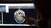 Un caso de enfermedad cerebral por fentanilo se documenta en el mundo por primera vez