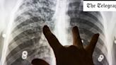 Pandemic disruptions caused 7,000 excess TB deaths in Europe, says report