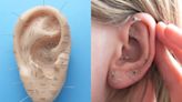 What are ear seeds, and how do they work?