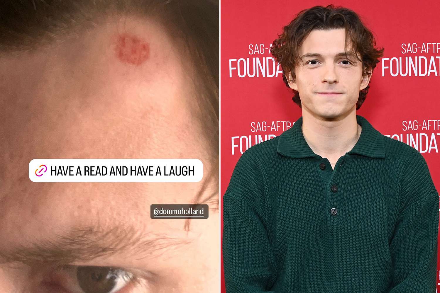 Tom Holland Shares Image of Painful Head Injury from Family Golf Day: ‘You Can Almost See the Dimples’