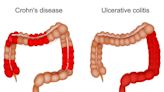 The Differences and Similarities Between Crohn's Disease and Ulcerative Colitis