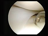 Arthroscopy