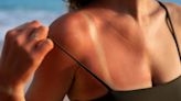 Remedios caseros para aliviar las quemaduras del sol en la piel